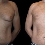 male breast surgery 1