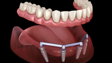 Dental Implants