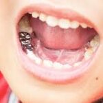 dental crows treatment