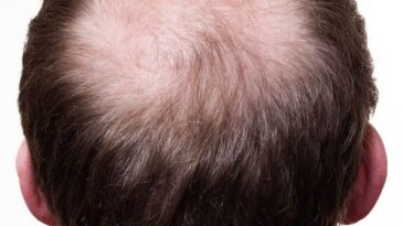 PRP Hair Therapy Cost in Dubai 3