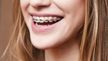 Braces 1024x680 1