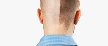 1111117131hairtransplantstockhdpngdownload