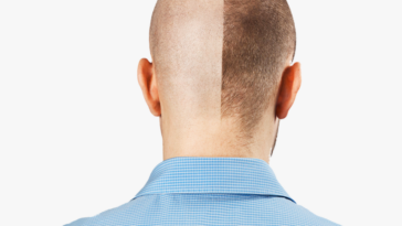 1111117131hairtransplantstockhdpngdownload