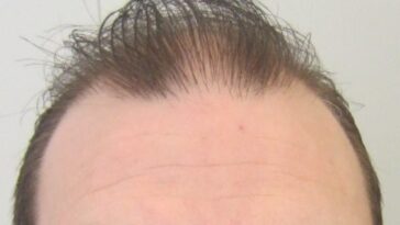 Hair Transplant in Dubai 9