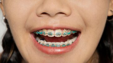 teeth braces 1296x728 header