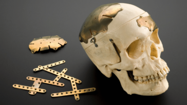 cranioplasty intro image 08 23