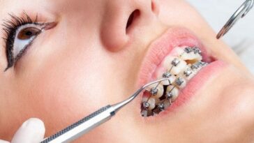 ortho braces spotlight1