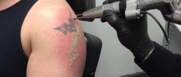 Tatoo removal 1024x576 1