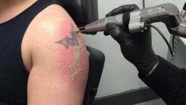 Tatoo removal 1024x576 1