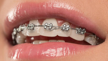 Durable metal braces for a perfect smile