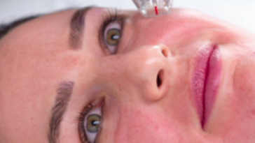 Top Benefits of Micro Needling for Acne Scars in Dubai 1