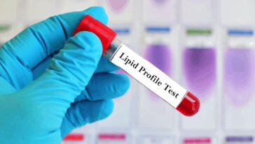 lipid test