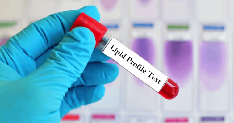 Lipid Profile Test: Importance, Procedure, and Benefits 1 lipid test