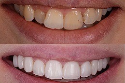 Dental Veneers Cost In Dubai15 2