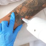 Does Laser Tattoo Removal Leave Scars? A Detailed Guide for Dubai Resi 21 preparing for tattoo removal 1920px