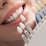 The Journey to a Flawless Smile in Dubai 20 Dental Veneers Cost In Dubai12