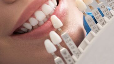 Dental Veneers Cost In Dubai12