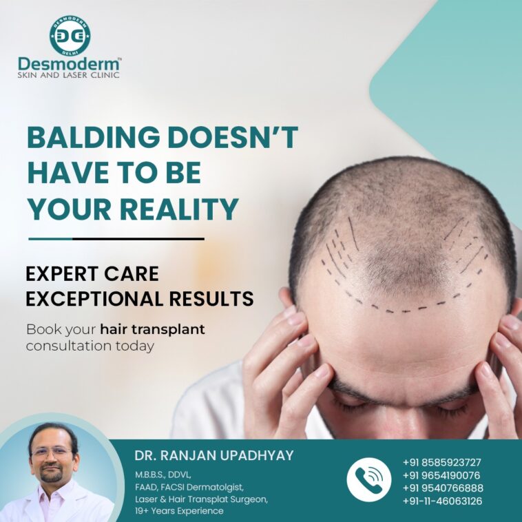 Hair Transplant for long hair: A Trend Amongst the Elite in Delhi 1 hair transplant in delhi desmoderm