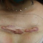 Keloid Treatment Empower Your Skin Healing Journey 20 013