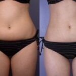 The Ultimate Guide to Laser Liposuction in Dubai Benefits Costs and 1