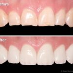 Dental Veneers Cost In Dubai16 1