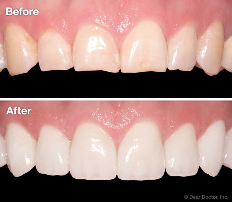 Dental Veneers Cost In Dubai16 1