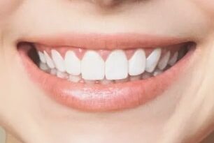 Dental Veneers Cost In Dubai14