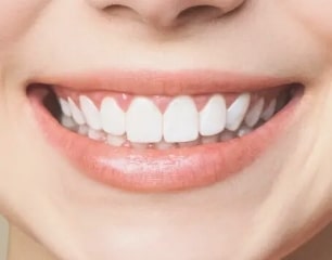 A Comprehensive Guide to Dental Veneers in Dubai 1 Dental Veneers Cost In Dubai14