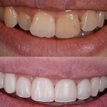 Long-Lasting Results with Dental Veneers: A Comprehensive Guide 21 Dental Veneers Cost In Dubai15 3
