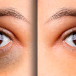 Effective Solutions for Dark Circles Treatment in Dubai What Works Be 2