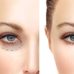 Blepharoplasty in Riyadh: A Step-by-Step Guide to a Refreshed Look 21 blepharoplasty in riyadh2