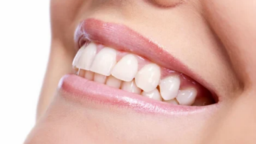 Smile brighter with composite veneers in Dubai