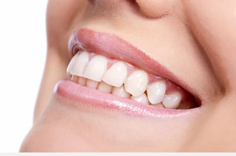 Perfect Your Smile with Composite Veneers in Dubai 1 Smile brighter with composite veneers in Dubai