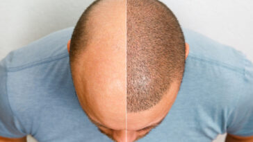 hair transplant in dubai