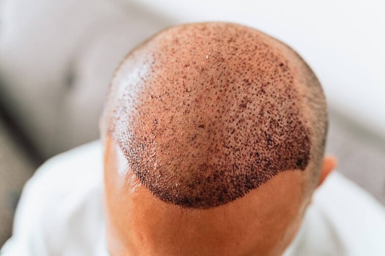 Hair Transplant in Dubai 2