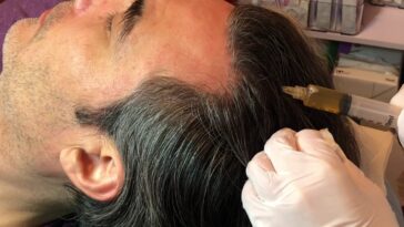 How PRP Hair Treatment Helps Restore Hair After Stress or Illnes