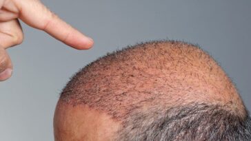 Hair Transplant in Dubai 12