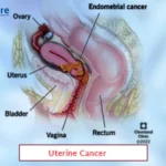 Uterine cancer treatment 21 1717658385uterine 2