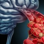 Transient Ischemic Attack Market 1
