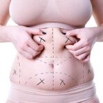 How a Tummy Tuck Can Enhance Your Body Contour 21 Tum T 14 1