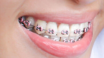 Enhance your smile with metal braces