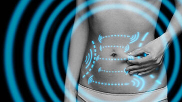 4D Vaser liposuction in Riyadh 25