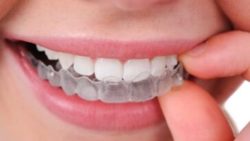 Aligner Invisalign
