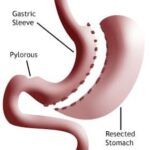Laparoscopic Sleeve Gastrectomy Cost in Riyadh 6