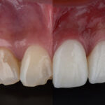 Composite veneers your solution to a beautiful smile