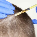 Best PRP Hair Treatment in Dubai 23