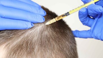 Best PRP Hair Treatment in Dubai 23