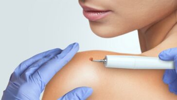 la dermatologist for mole removal 1