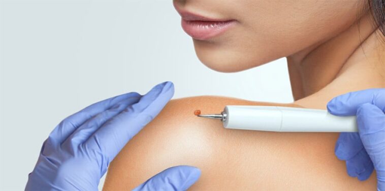 What Does Mole Structure Indicate? 1 la dermatologist for mole removal 1