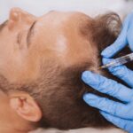 How Does PRP Improve Hair Growth Cycles? 20 wellness hair restoration prp are prp results permanent 1